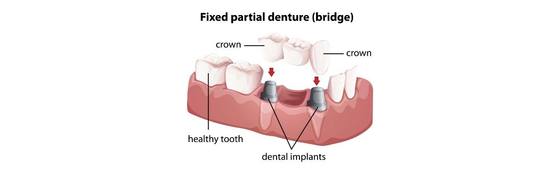 Dental Crowns and Bridges