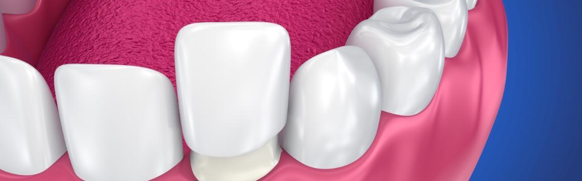 Dental Veneers