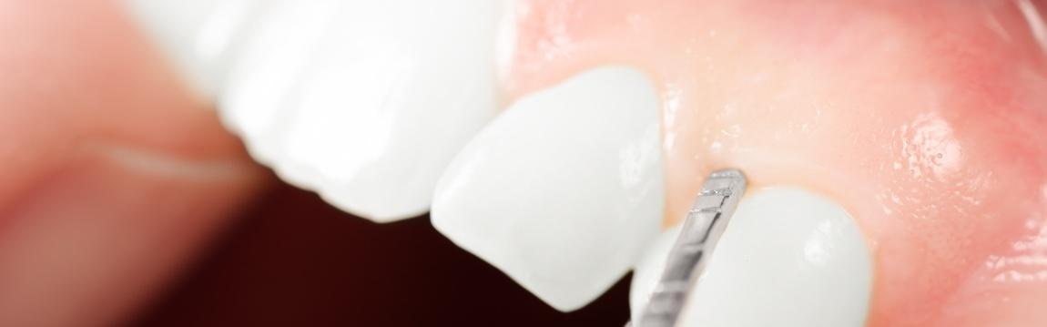 Gum Grafts