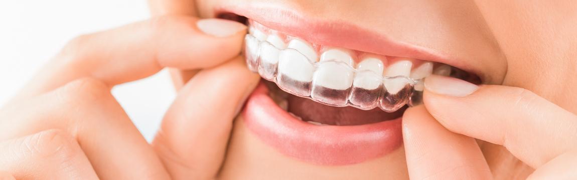 Teeth Straightening With Invisalign