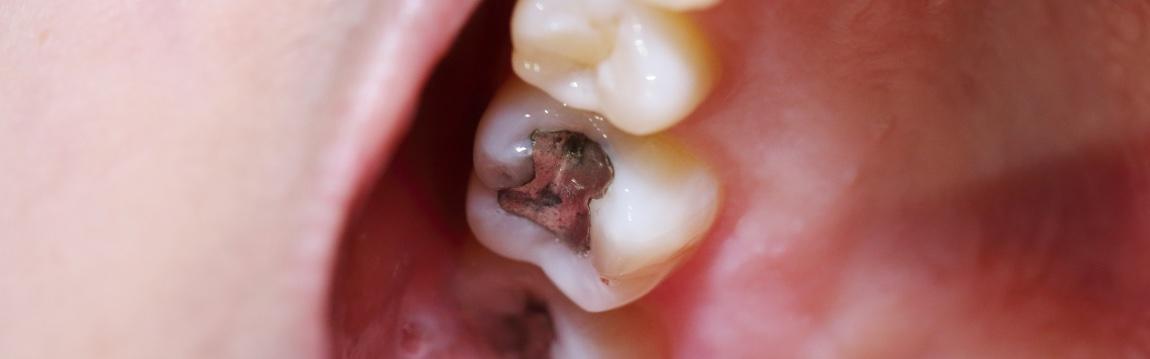 Old and Unsightly Fillings