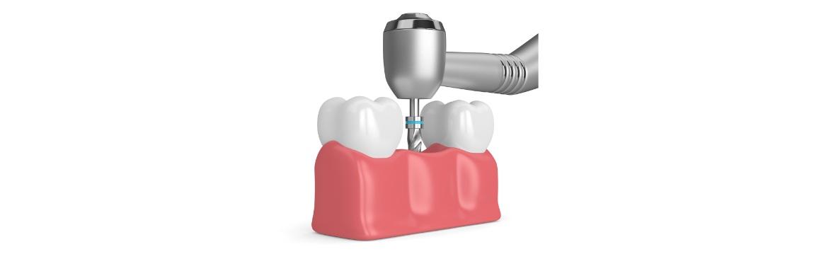 Ridge augmentation