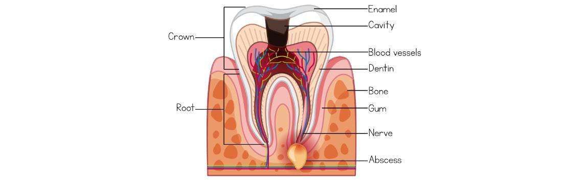 Abscessed Tooth