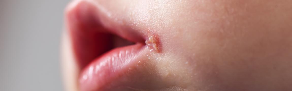 canker sore on cheek near wisdom tooth