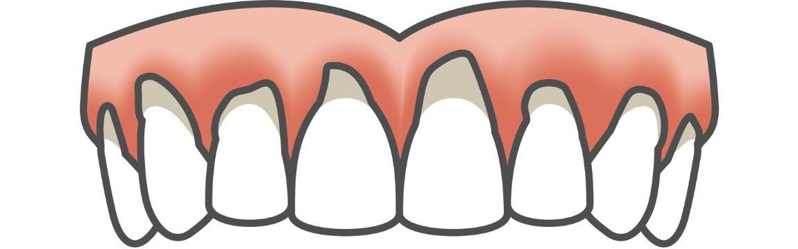 Excessive or Uneven Gums