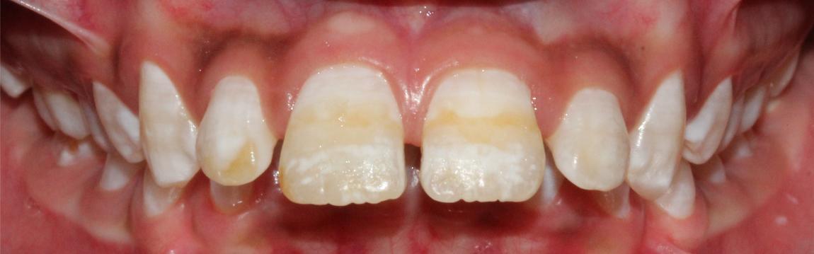 fluorosis