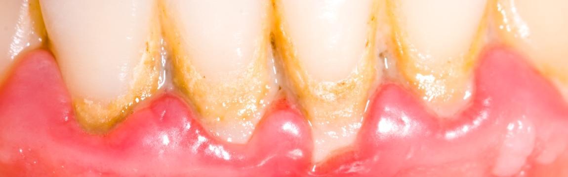 plaque on teeth