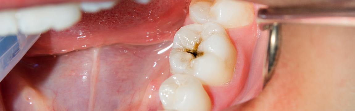 tooth decay cavity