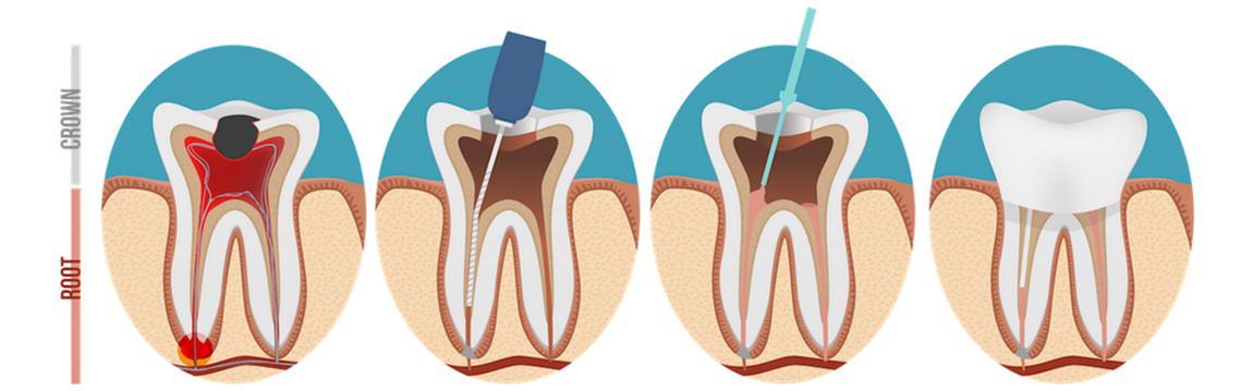 Root Canal Therapy