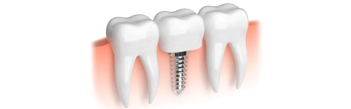 Dental Implants