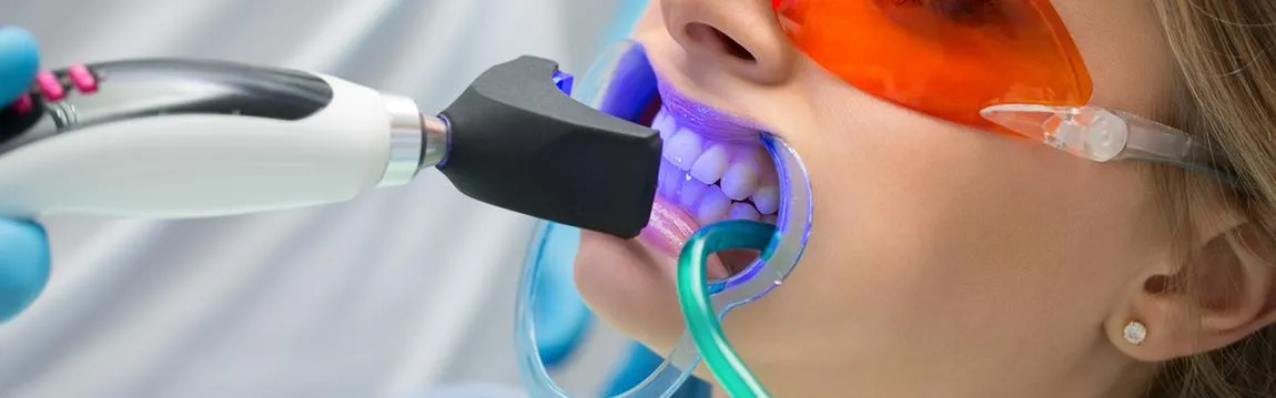 Teeth Whitening Tooth Whitening