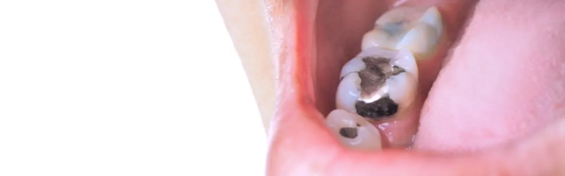 Amalgam Silver Fillings