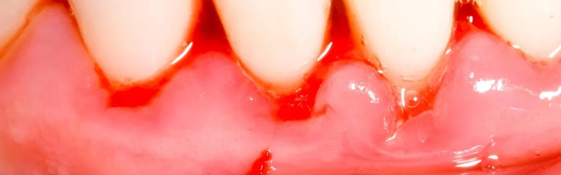 oral lacerations or cuts