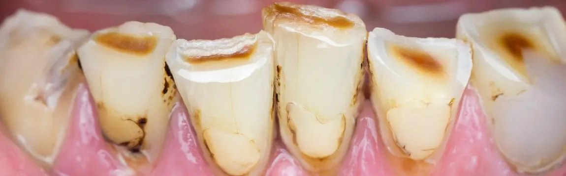 Teeth After Bulimia Nervosa