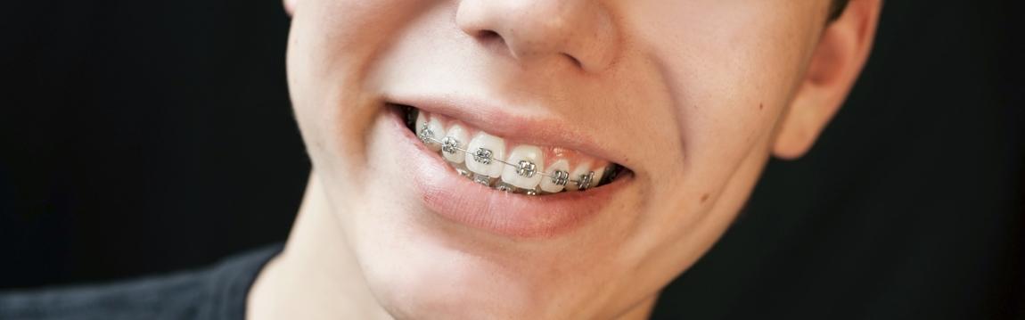 braces for a better smile