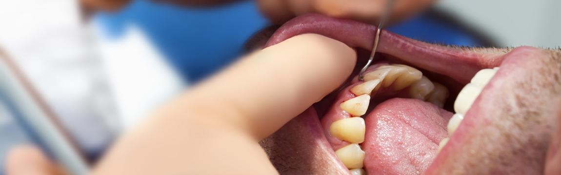 Periodontal Surgery or Flap Surgery Periodontal Surgery or Flap Surgery