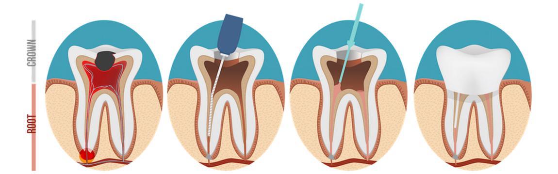 Root Canal - Root Canals
